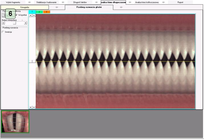 Okno analizy kimograficznej nagrania HSV – Analiza kimo długoczasowa -> Przebieg rozwarcia głośni