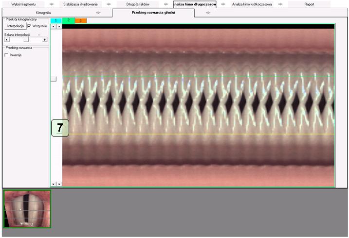 Okno analizy kimograficznej nagrania HSV – Analiza kimo długoczasowa -> Przebieg rozwarcia głośni