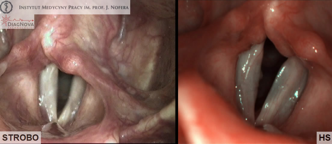 szybka kamera diagnostyka laryngologiczna foniatryczna